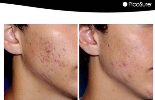 acne-laser-treatment-oshawa